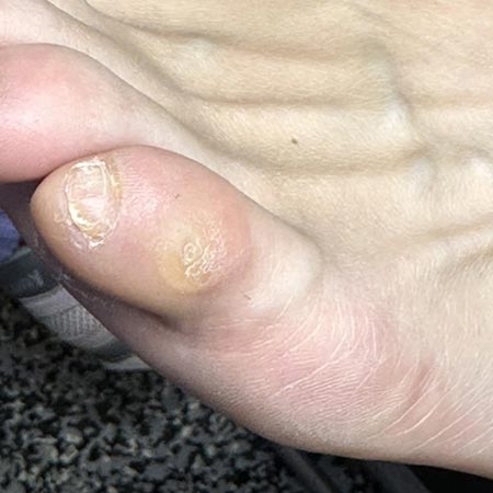 Pedicure sanitaria occhio di pernice