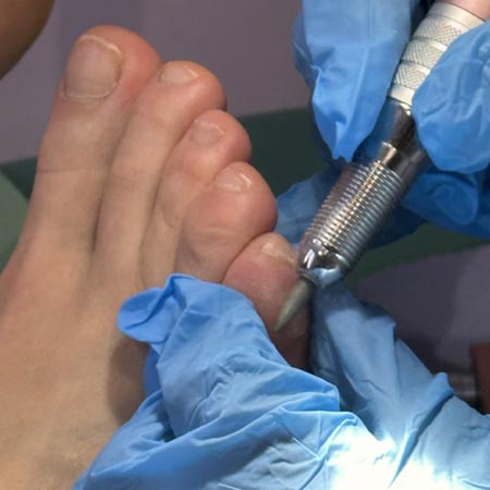 Pedicure sanitaria occhio di pernice