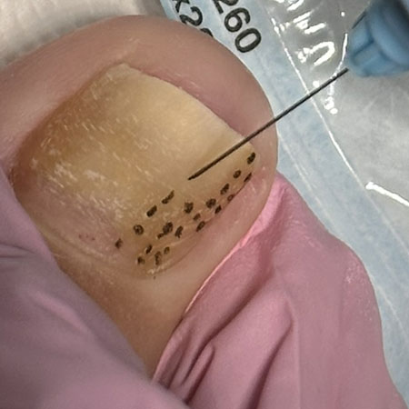 Micosi all'unghia del piede trattata con lancia al plasma