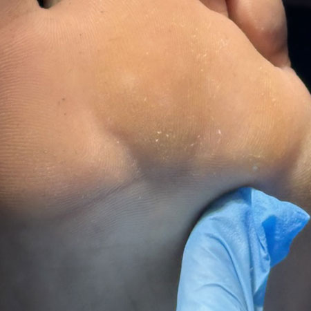 Le verruche ai piedi e l'infezione da HPV