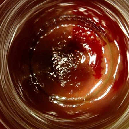 Ragade anale cronicizzata
