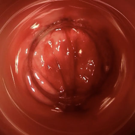 ragade con fistola