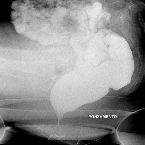 Defecografia