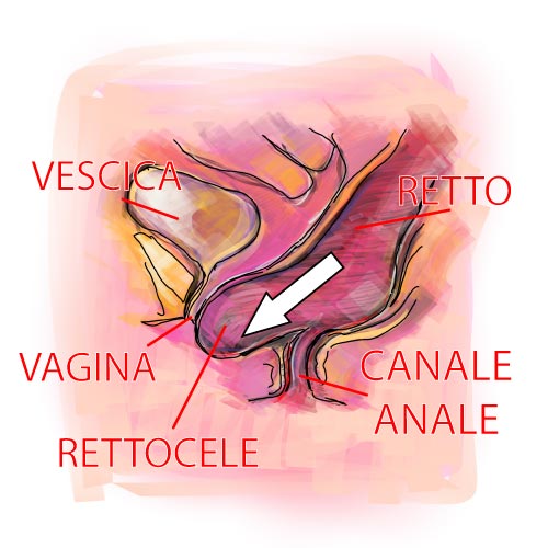 Rettocele e prolasso del retto in vagina