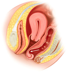 Il rettocele e l'erniazione del retto in vagina