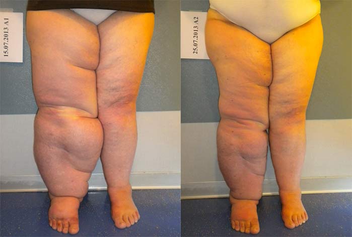 Il trattamento del linfedema a Milano