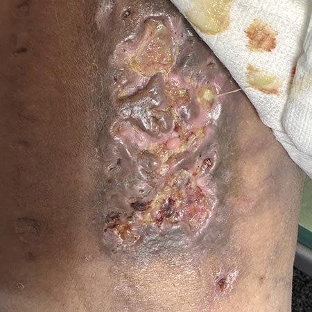 Ulcera venosa su paziente tossicodipendente