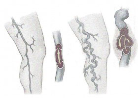 Sindrome post trombotica