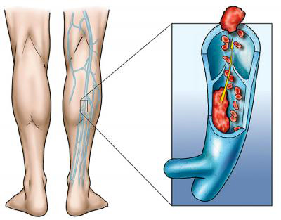 Trombosi venosa profonda
