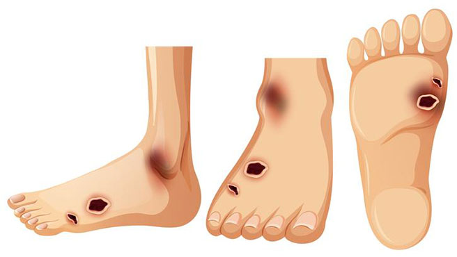 La patologia del piede diabetico