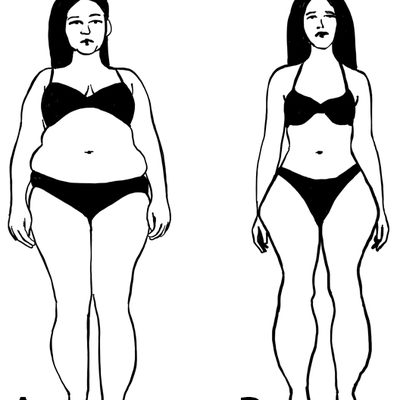 La prevenzione, la diagnosi e la terapia per il lipedema nella giovane ragazza