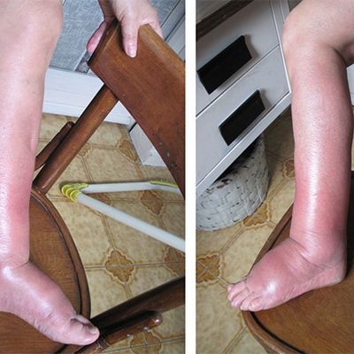 Linfodrenaggio e trattamento del linfedema