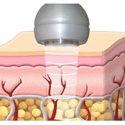 Ultrasuonoterapia per dolori muscolari ed articolari