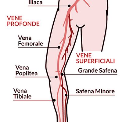 Cos'è la flebite?