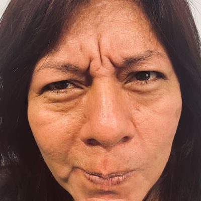 La tossina botulinica e il Botox antirughe