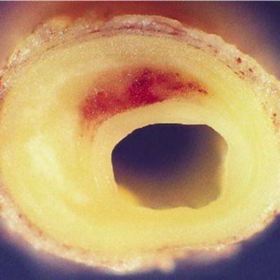 La Claudicatio Intermittens e l'insufficienza arteriosa