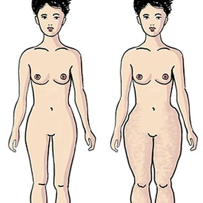 Il lipedema e il grasso delle cosce che non riesce ad andare via