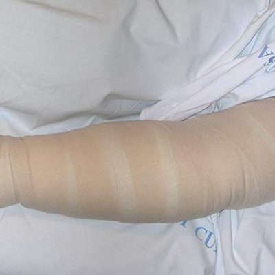 La Terapia Complessa Decongestiva