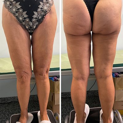 Medicina Estetica per le gambe delle donne over 50