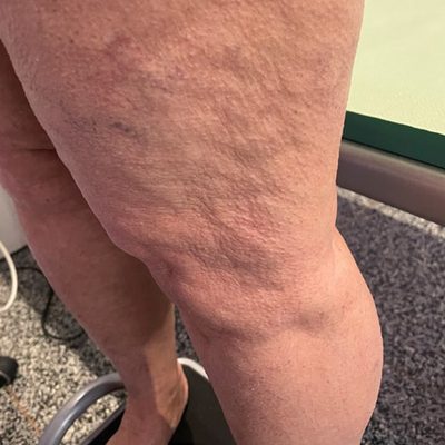 La biorivitalizzazione delle gambe