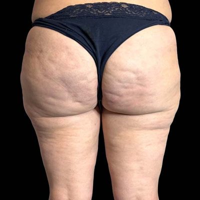 La cellulisi e la riduzione mini-invasiva della cellulite