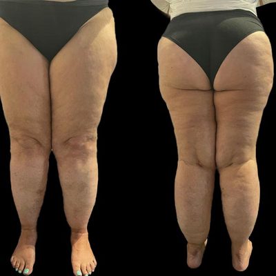 Le gambe grosse: si può fare qualcosa?