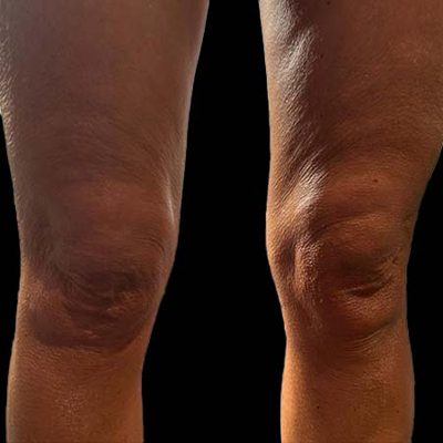 Il lifting delle cosce, medico e chirurgico
