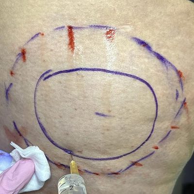 La mesoterapia Lipodissolve per eliminare cellulite e grasso sulle gambe