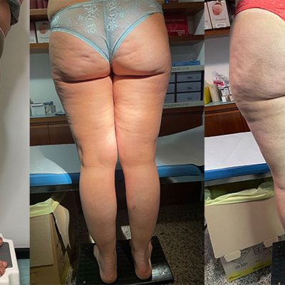 Il trattamento anticellulite ElastSkin