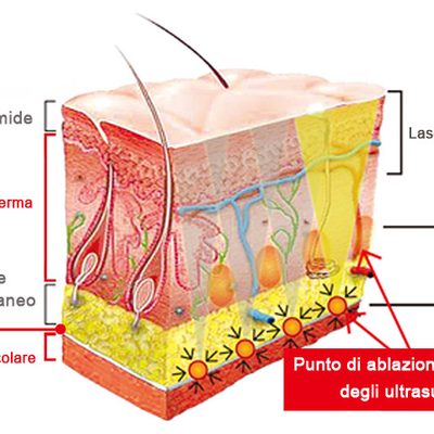 Il trattamento HiFu: il lifting non chirurgico per addome e gambe