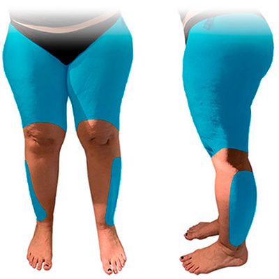 La Liposuzione a Zone Selettive per rimuovere il lipedema