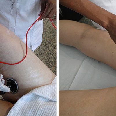La Radiofrequenza Medica per combattere cellulite ed inestetismi delle gambe