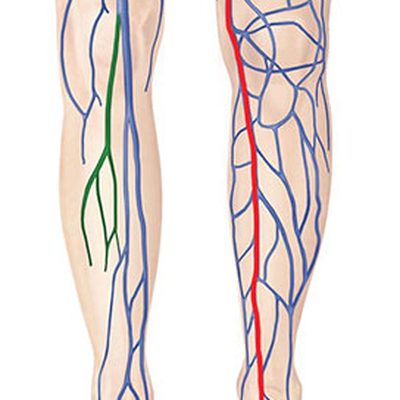 La safenectomia, la termoablazione e l'insufficienza venosa