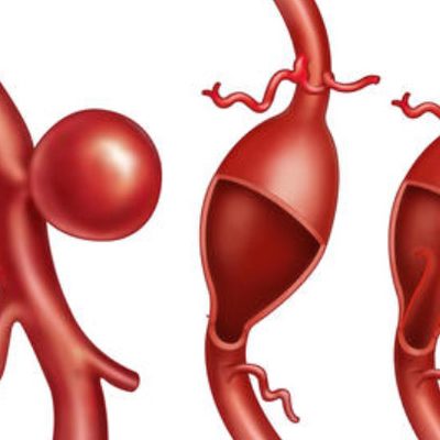 Lo screening dell'aorta addominale