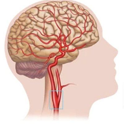 Lo screening delle carotidi: un esame salvavita