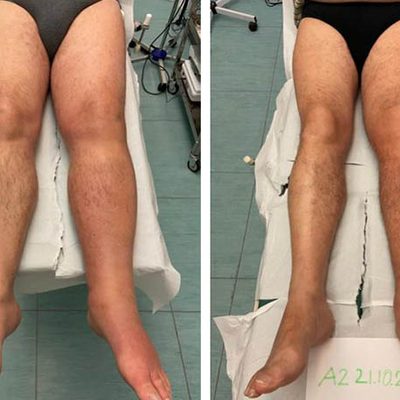 La Terapia Complessa Decongestionante contro il linfedema