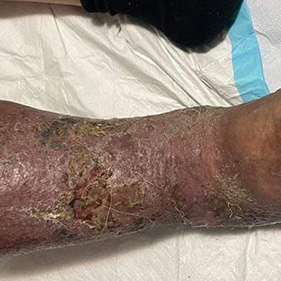 Vulnologia: trattamento e cura delle ulcere gravi