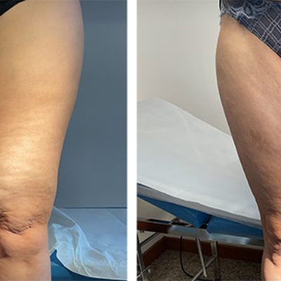 Perché ho così tanta cellulite?