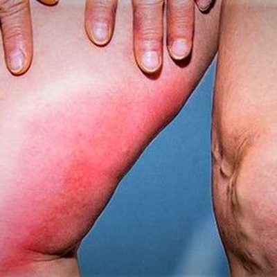 Il dolore acuto ed improvviso alla gamba