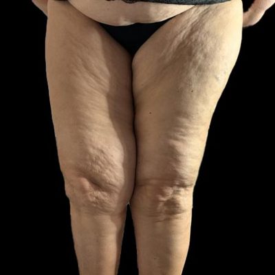 Il dolore al tatto e alla palpazione delle gambe e delle cosce