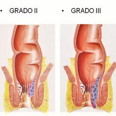 Le emorroidi durante la gravidanza e il parto