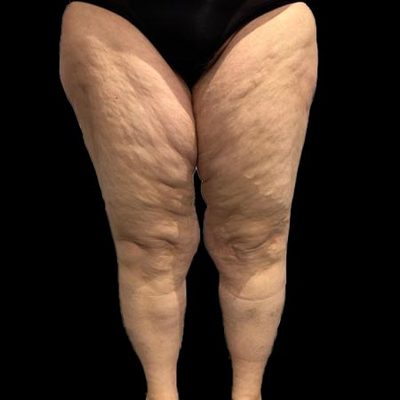 Gambe e cosce enormi e sproporzionate