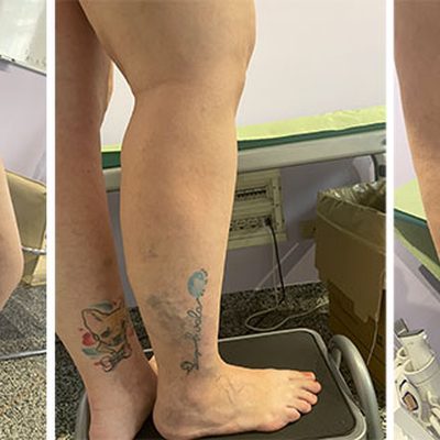 Le gambe gonfie e dolenti durante la gravidanza