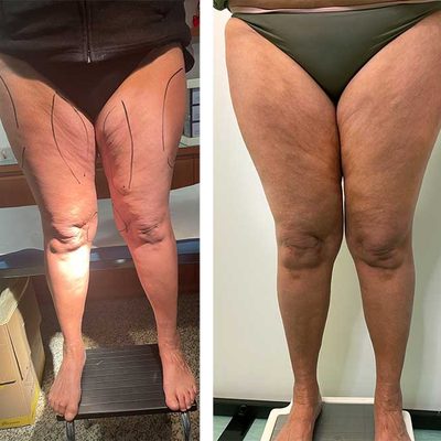 La pelle delle gambe con rughe e prolasso