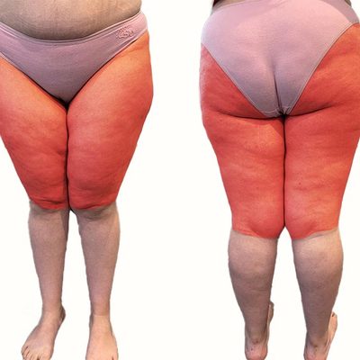 Perché non perdo peso su cosce e gambe?