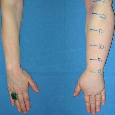 Il rigonfiamento di un braccio o di una gamba dopo un’operazione di asportazione tumorale