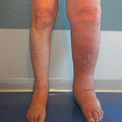Il rigonfiamento improvviso di un braccio o di una gamba