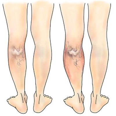 Le vene sporgenti sulle gambe