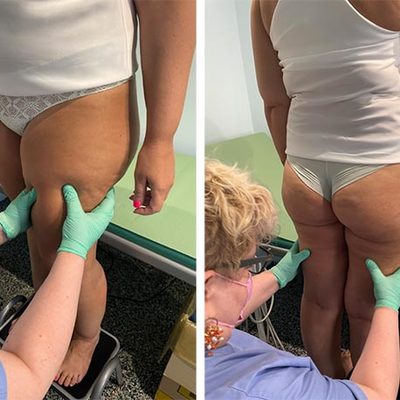Dieci cose da sapere sul lipedema