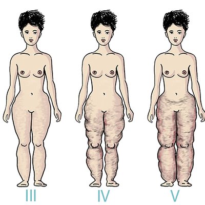 La liposuzione LRS per il lipedema a Milano: domande e risposte